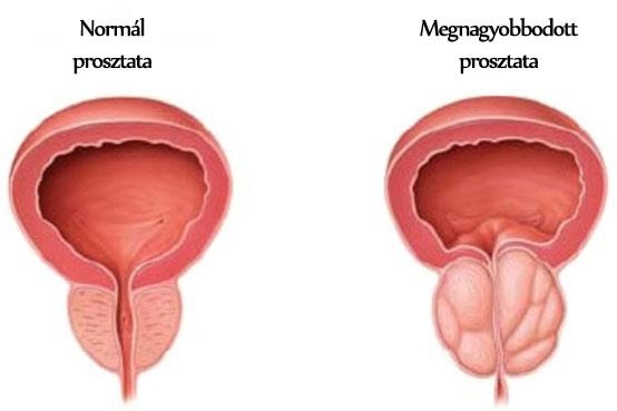 Saw Palmetto, jóindulatú prosztata megnagyobbodás, kopaszodás
