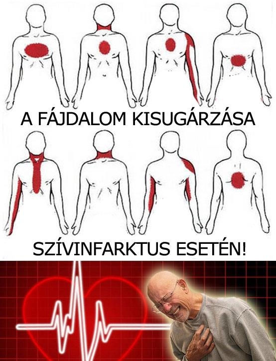 A fájdalom kisugárzása szívinfarktus esetén