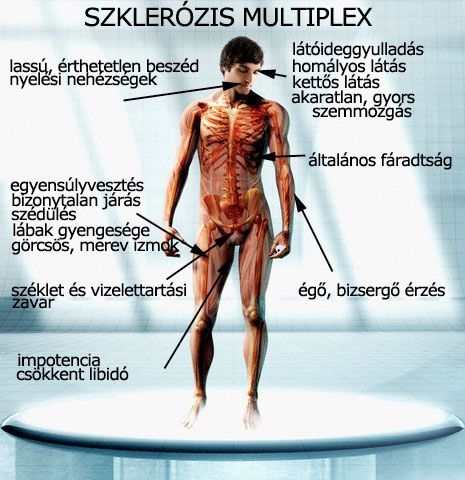 Szklerózis multiplex
