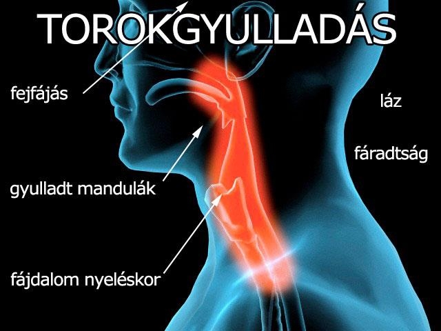 Torokgyulladás