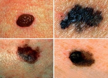 Melanoma - bőrrák