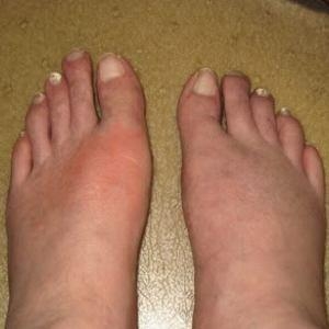 A paleolit diéta és a köszvény