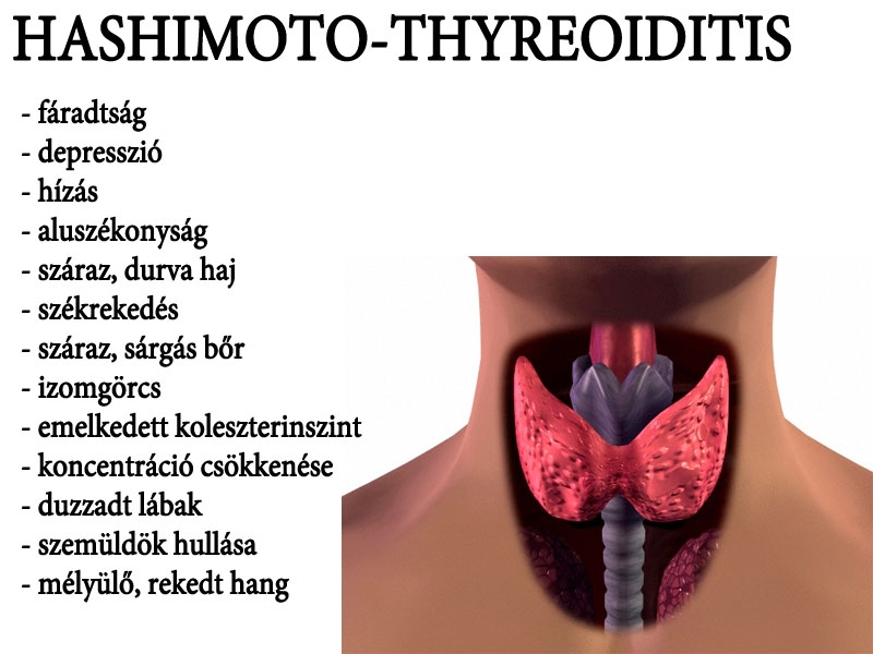 Hashimoto-thyreoiditis
