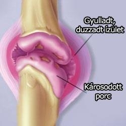 A brokkoli és az ízületek