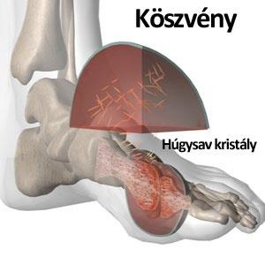 Köszvény, fruktóz, lúgosítás