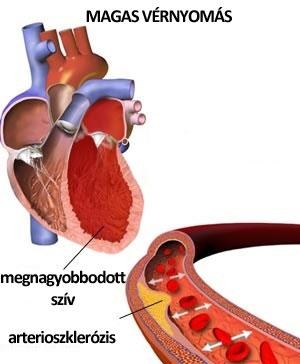Vérnyomás problémák