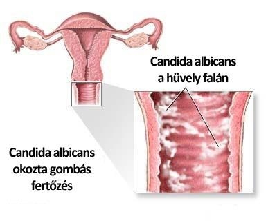 Candida albicans okozta fertőzés