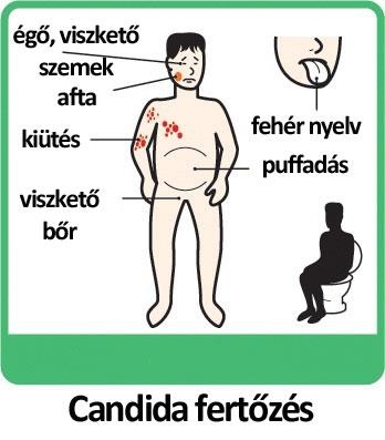 Candida fertőzés