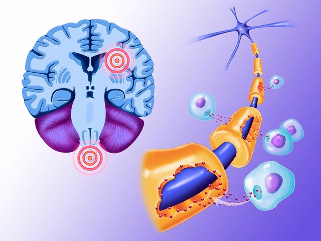 D vitamin vs. szklerózis multiplex (SM)