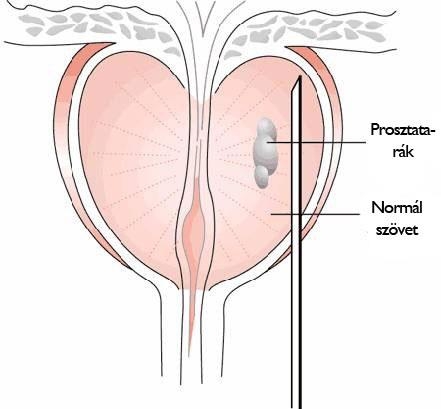 Omega 3 halolaj vs. prosztatarák