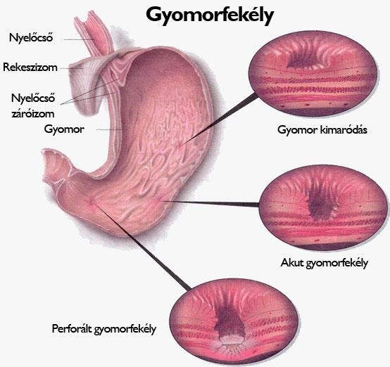 Gyomorfekély