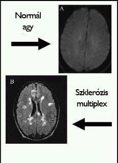 Szklerózis multiplex (SM)
