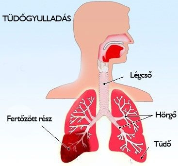 Tüdőgyulladás