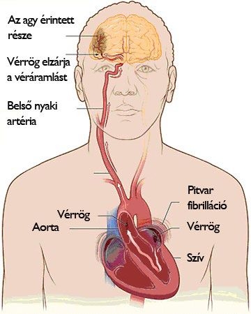 Arterioszklerózis kialakulása