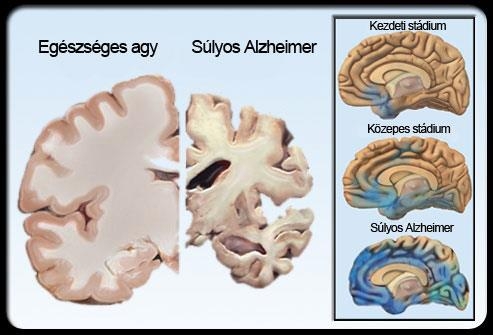 D-vitaminnal az Alzheimer-kór ellen?