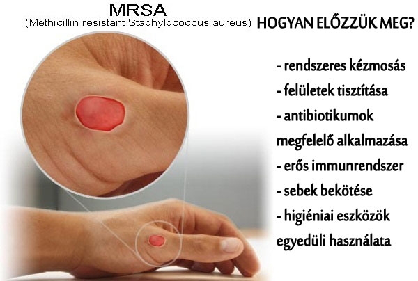 MRSA fertőzés