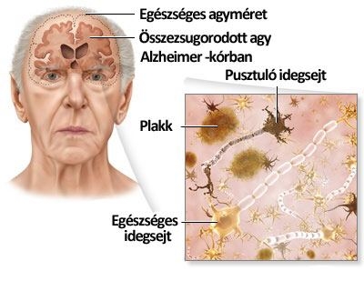 „Fertőző” Alzheimer-kór?
