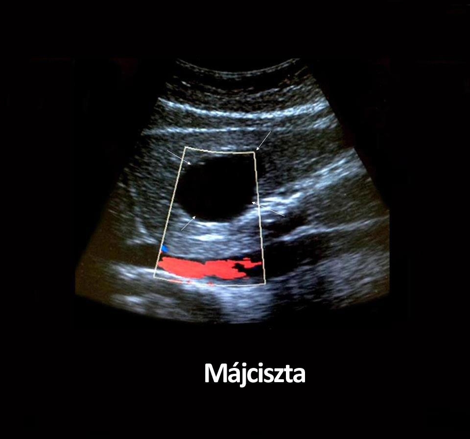 Májciszta