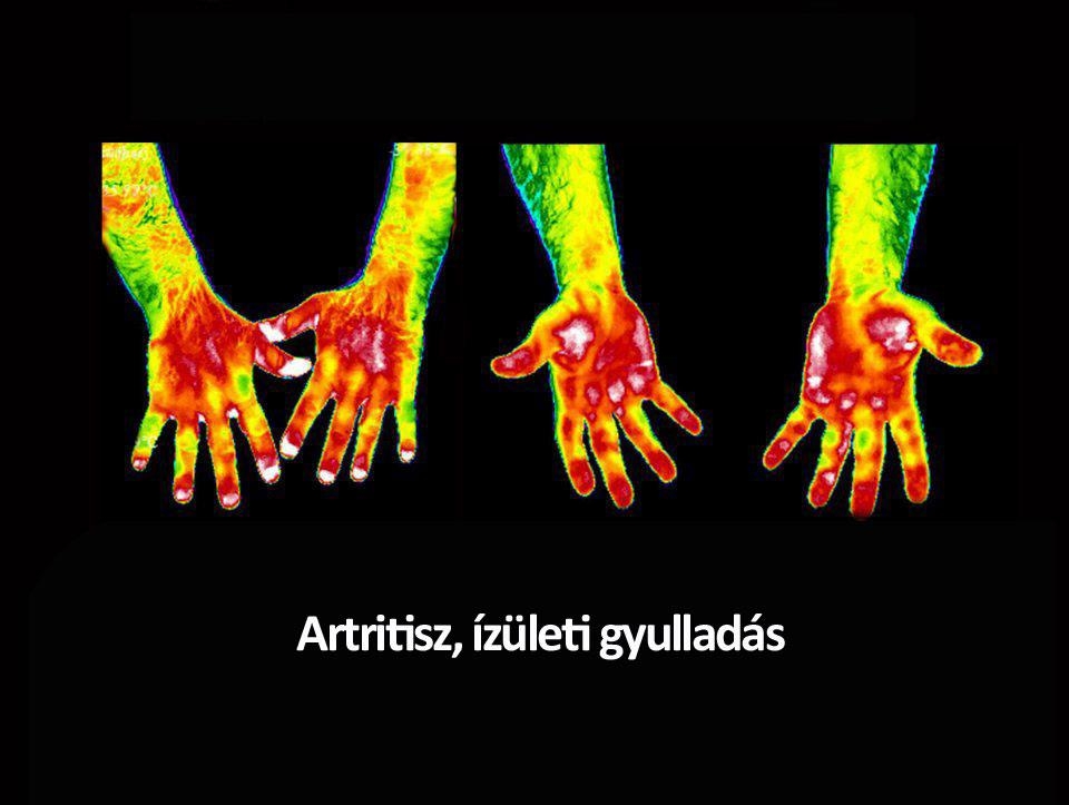 Artritisz, ízületi gyulladás