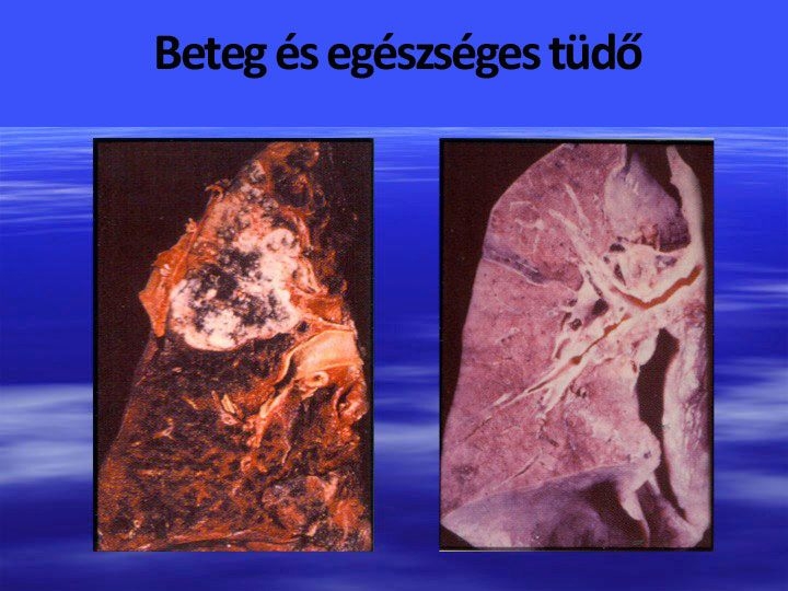 Beteg és egészséges tüdő