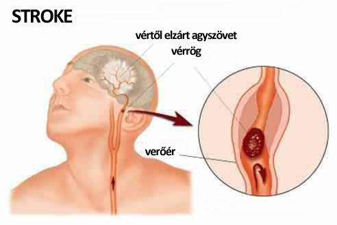 A koleszterin és a stroke