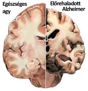 „Fertőző” Alzheimer-kór?