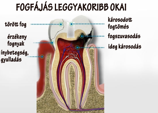 Fogfájás leggyakoribb okai