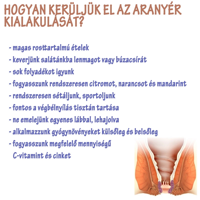 Hogyan kerüljük el az aranyér kialakulását?
