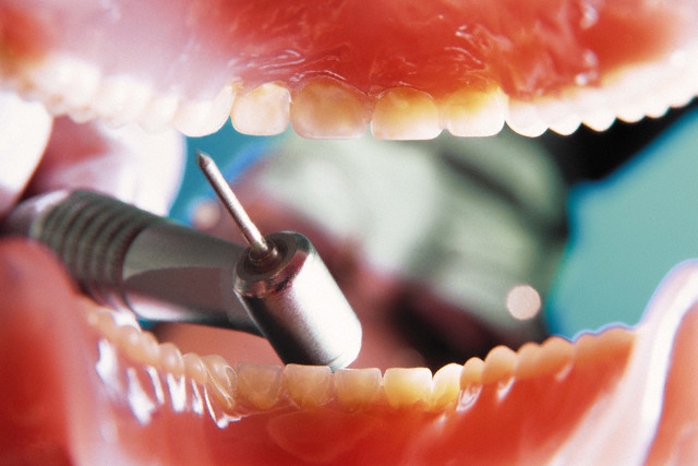 Miért kell lecserélni az amalgámtöméseket?