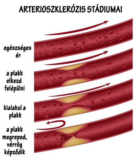 Az érelmeszesedés korunk népbetegsége