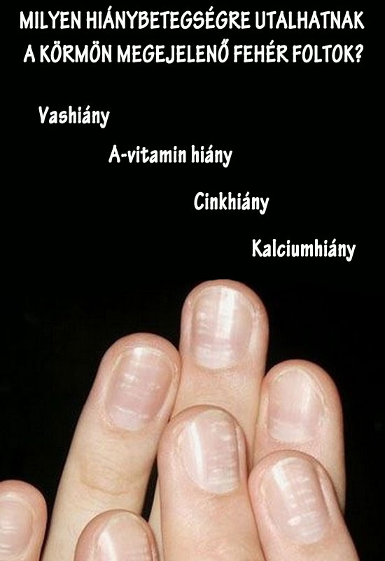 Fehér foltok a körmökön?