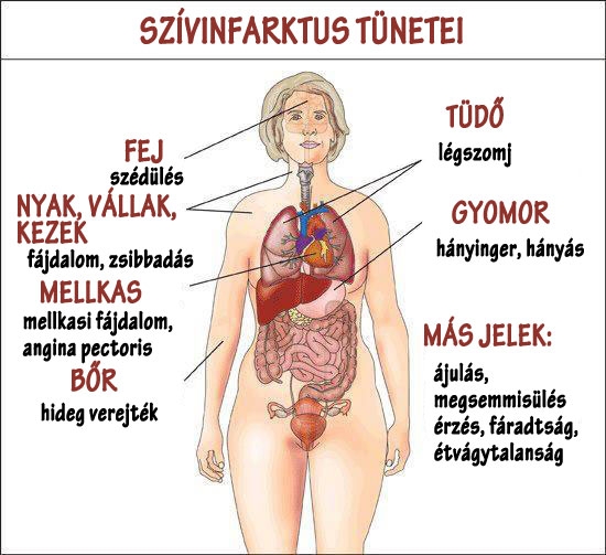 Szívinfarktus tünetei