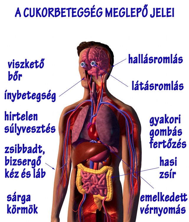 A cukorbetegség - meglepő jelek
