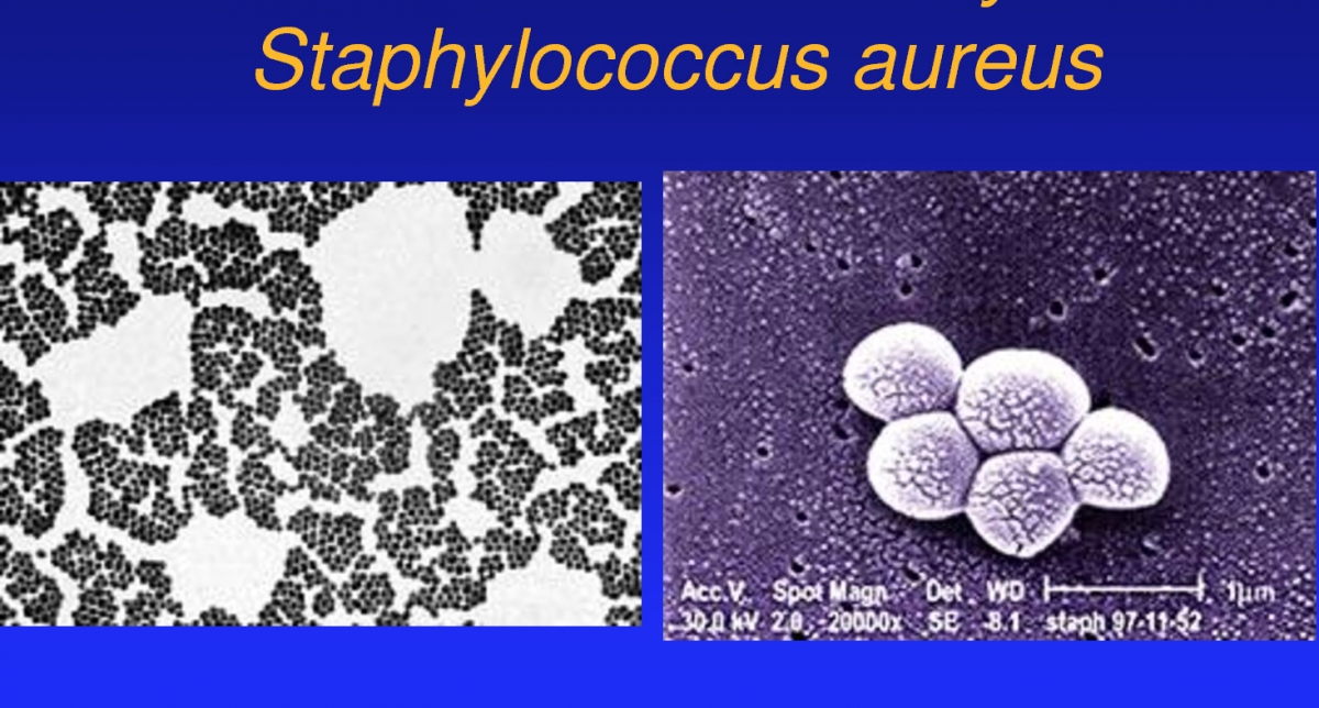Staphylococcus fertőzés