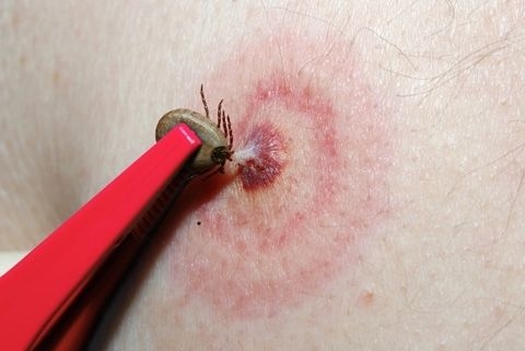 A Lyme-kór