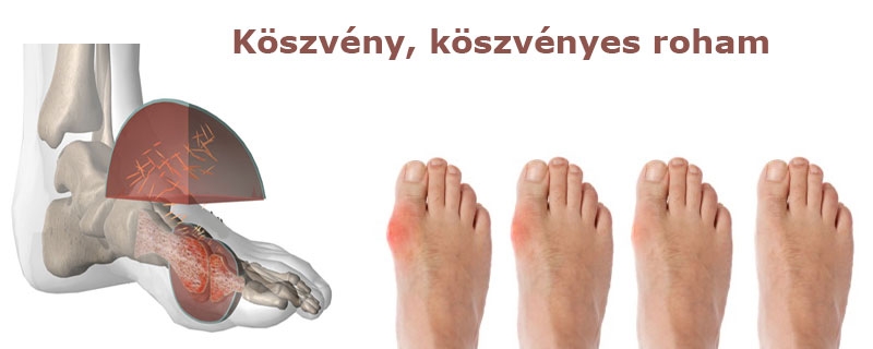 Köszvény, táplálkozás, lúgosítás