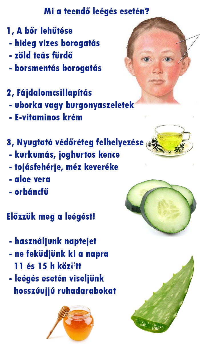 Természetes gyógymód leégésre