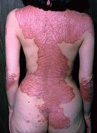 Otthoni gyógymódok a pikkelysömör tüneteinek enyhítésére