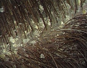 Házi praktikák a korpásodás kezelésére