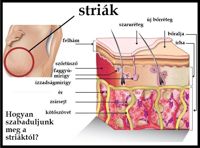 Szabaduljunk meg gyorsan a striáktól!