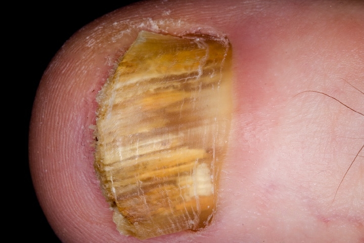 A köröm gombás fertőzése