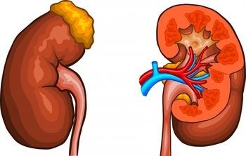 A mellékvese-kimerültség tünetei és hét módszer a mellékvese mirigyeinek gyógyítására