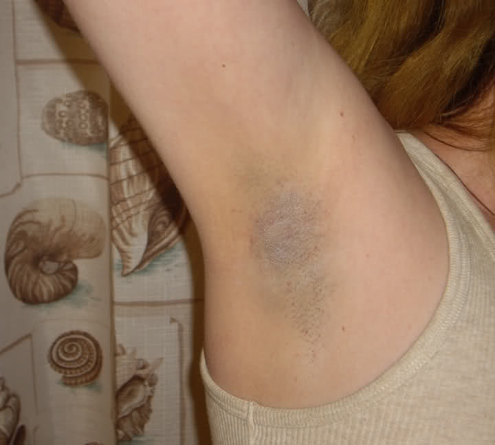 10 gyógymód sötét hónalj ellen