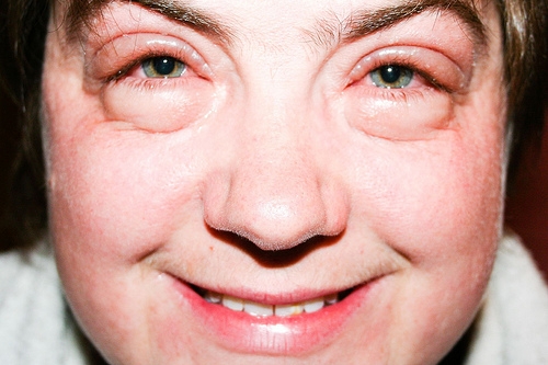 10 gyógymód duzzadt szemek ellen