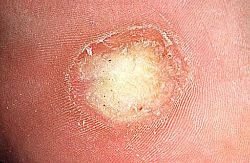 Otthoni gyógymódok szemölcsök kezelésére