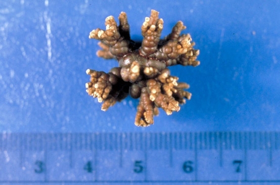 Otthoni gyógymódok vesekő ellen