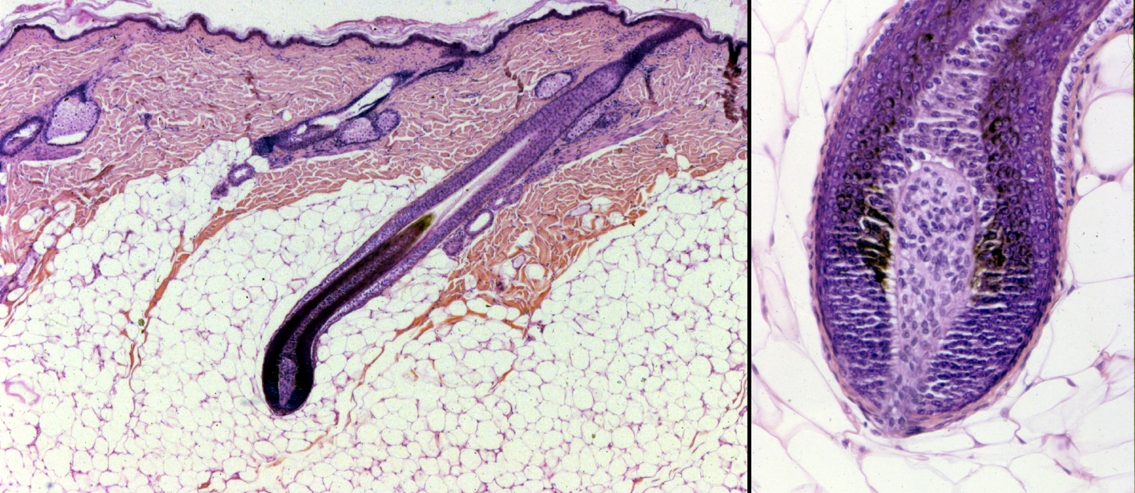 Hogyan szabaduljunk meg a belső combon kialakuló szőrtüszőgyulladástól?