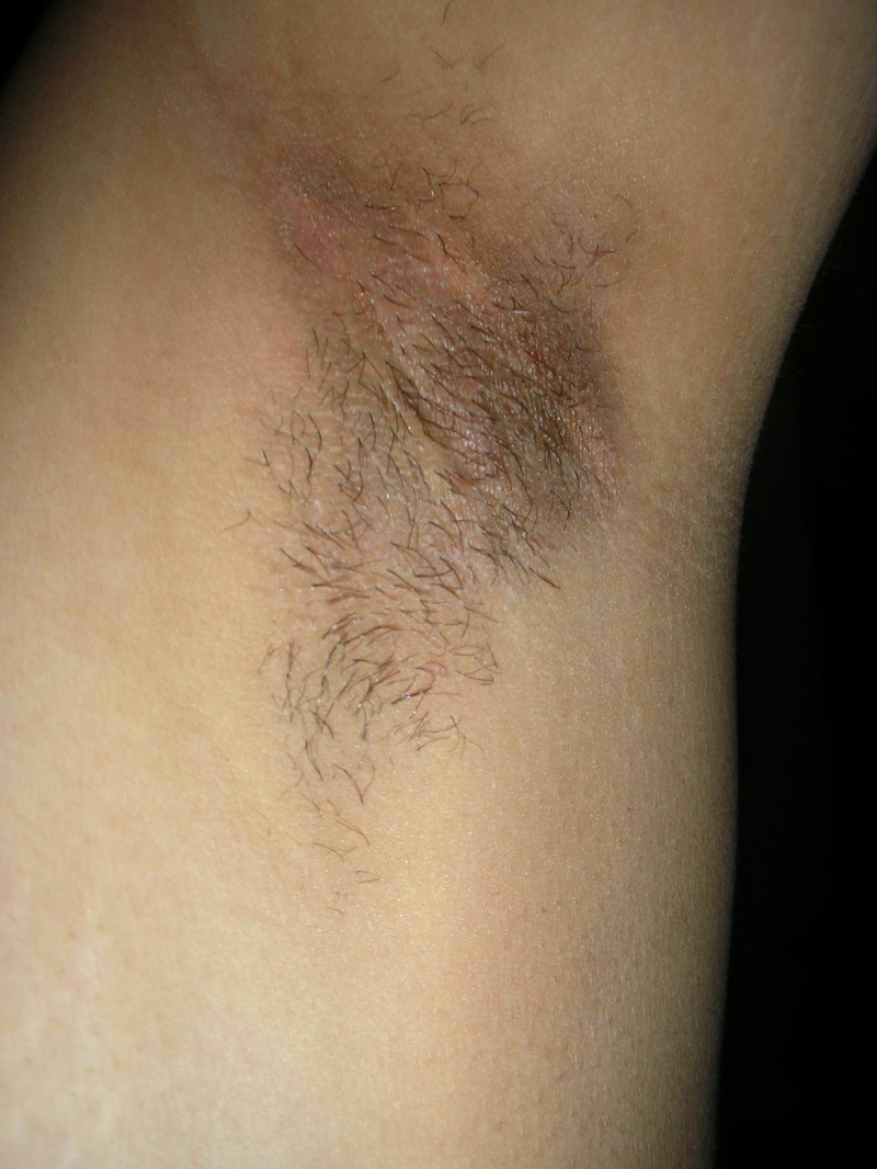 Hogyan szabaduljunk meg a sötét hónaljtól?