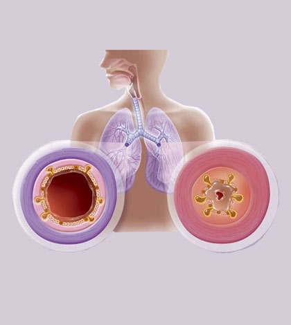 Otthoni gyógymódok hörghurut ellen