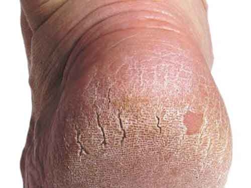 Otthoni gyógymódok repedezett sarkak ellen